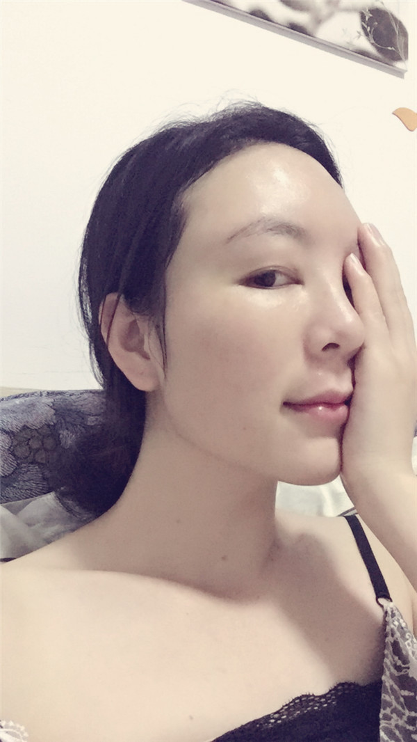 大家新年好呀!2018年我来给你们分享我的自体脂肪填充脸部案例啦~~素颜照、美照都有哦,嘻嘻(#^.^#)