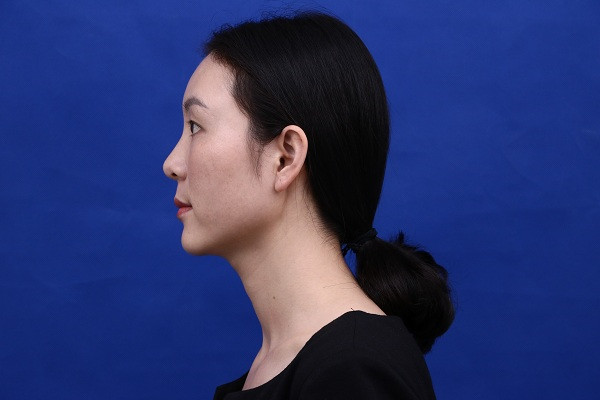 大家新年好呀!2018年我来给你们分享我的自体脂肪填充脸部案例啦~~素颜照、美照都有哦,嘻嘻(#^.^#)