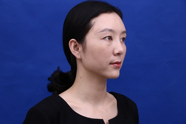 大家新年好呀!2018年我来给你们分享我的自体脂肪填充脸部案例啦~~素颜照、美照都有哦,嘻嘻(#^.^#)