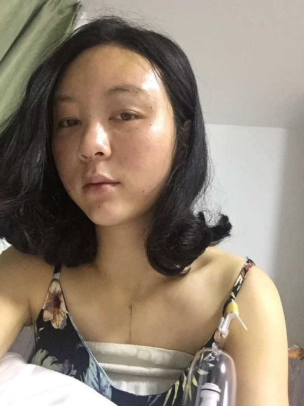 大家新年好呀!2018年我来给你们分享我的自体脂肪填充脸部案例啦~~素颜照、美照都有哦,嘻嘻(#^.^#)