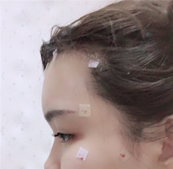 宝宝们，我去做了自体脂肪填充脸部，悄悄告诉你们，别人都看不出来我做了微整哈哈哈~~