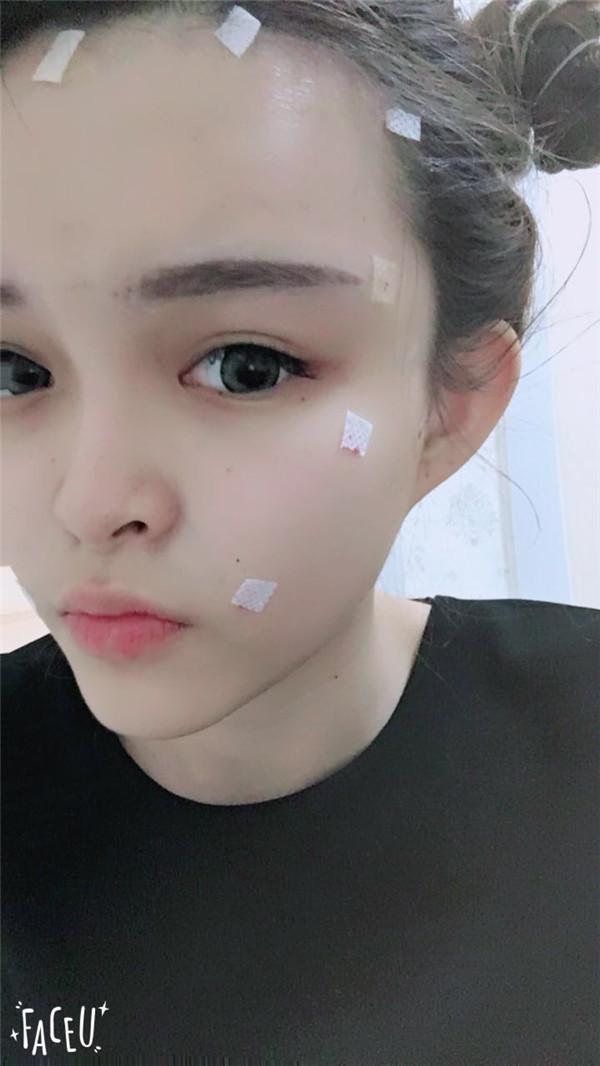 宝宝们，我去做了自体脂肪填充脸部，悄悄告诉你们，别人都看不出来我做了微整哈哈哈~~