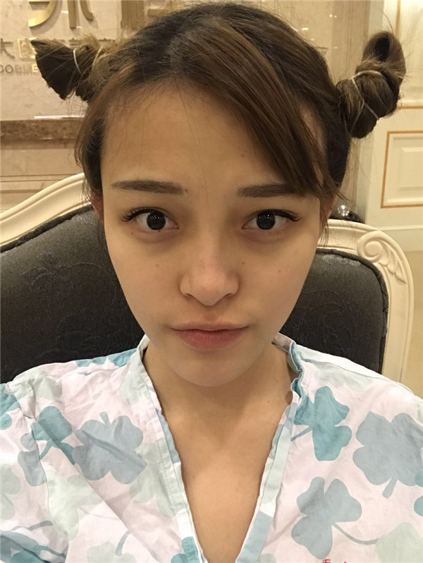 宝宝们，我去做了自体脂肪填充脸部，悄悄告诉你们，别人都看不出来我做了微整哈哈哈~~