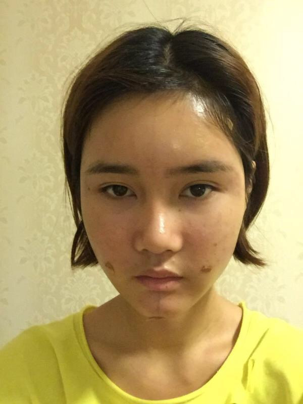 宝宝们,我来分享一下我的自体脂肪填充额头苹果肌,丰太阳穴的经历吧!有很多不懂得地方,希望你们可以多多给我变美的小妙招哦~~~