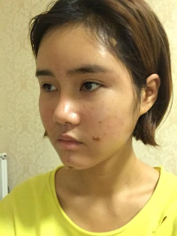 宝宝们,我来分享一下我的自体脂肪填充额头苹果肌,丰太阳穴的经历吧!有很多不懂得地方,希望你们可以多多给我变美的小妙招哦~~~