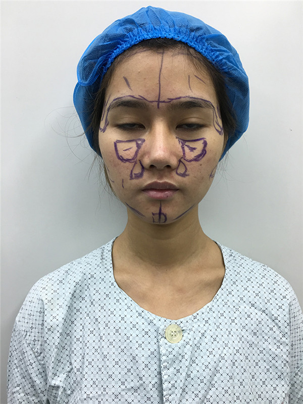 宝宝们,我来分享一下我的自体脂肪填充额头苹果肌,丰太阳穴的经历吧!有很多不懂得地方,希望你们可以多多给我变美的小妙招哦~~~