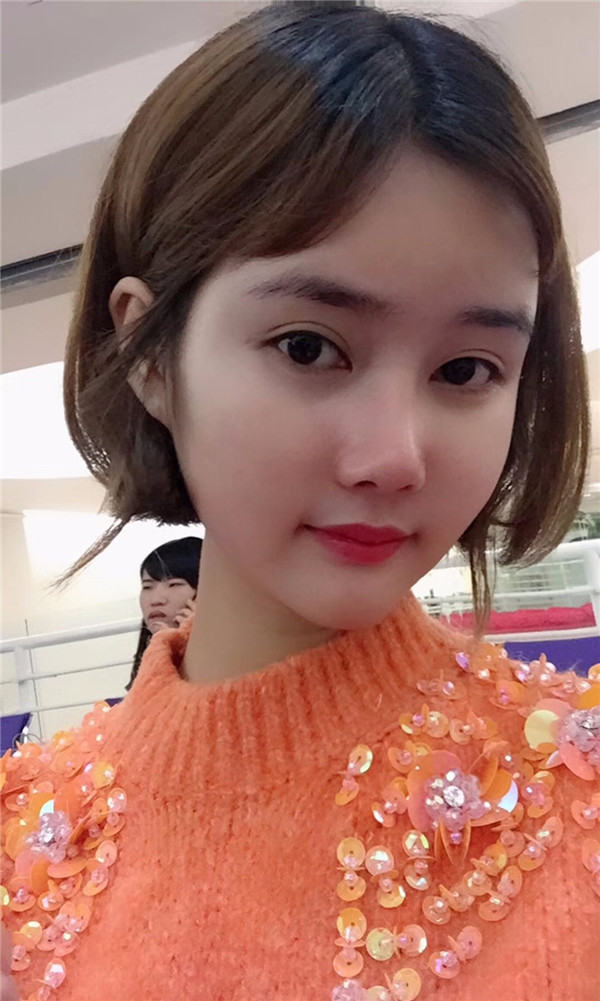 宝宝们,我来分享一下我的自体脂肪填充额头苹果肌,丰太阳穴的经历吧!有很多不懂得地方,希望你们可以多多给我变美的小妙招哦~~~