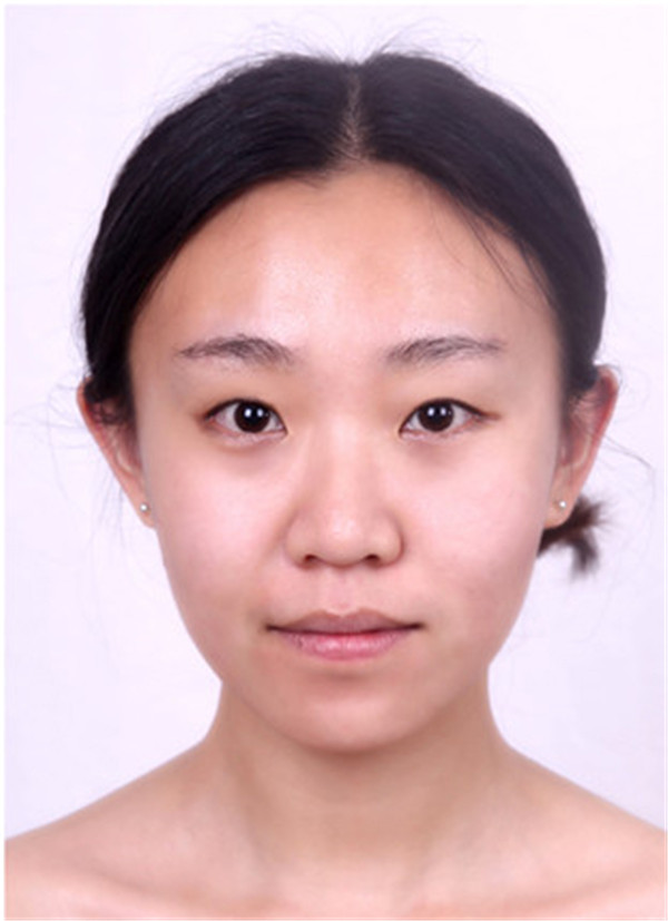 大家早上好,我来分享我的双眼皮经历啦!!都进来看看吧,只要注意忌口和听医生的话,是不会有疤痕的哦~~~