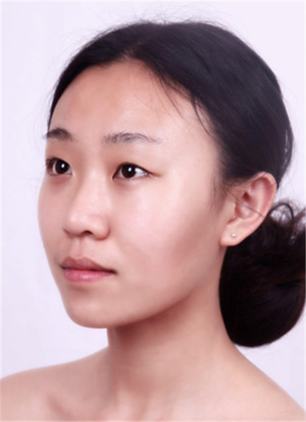 大家早上好,我来分享我的双眼皮经历啦!!都进来看看吧,只要注意忌口和听医生的话,是不会有疤痕的哦~~~