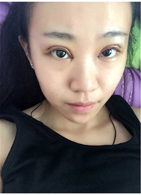 大家早上好,我来分享我的双眼皮经历啦!!都进来看看吧,只要注意忌口和听医生的话,是不会有疤痕的哦~~~