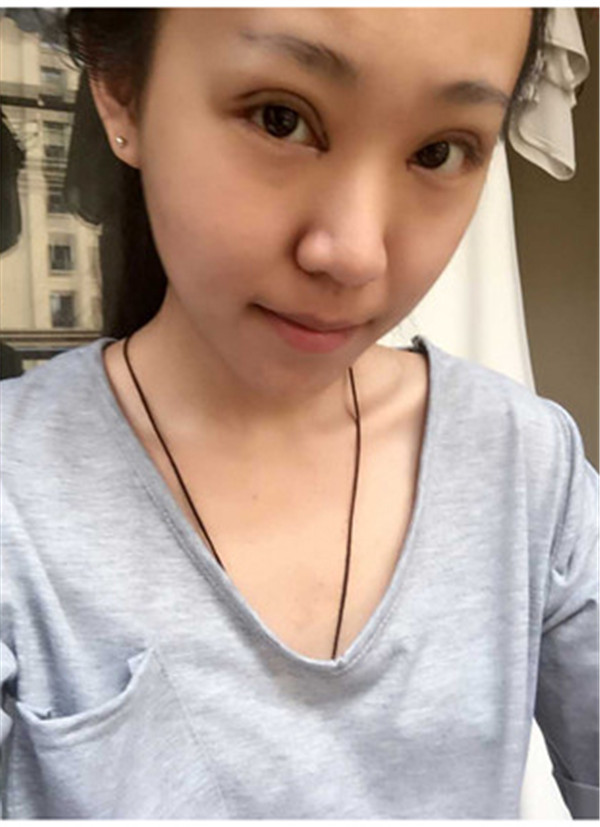 大家早上好,我来分享我的双眼皮经历啦!!都进来看看吧,只要注意忌口和听医生的话,是不会有疤痕的哦~~~