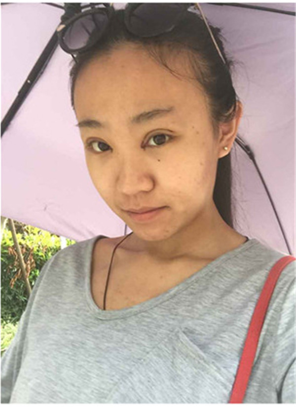 大家早上好,我来分享我的双眼皮经历啦!!都进来看看吧,只要注意忌口和听医生的话,是不会有疤痕的哦~~~