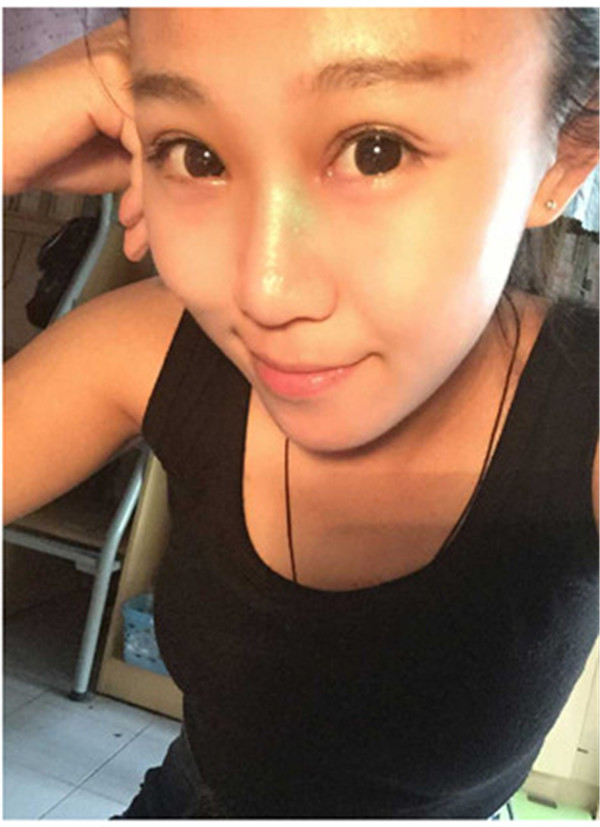 大家早上好,我来分享我的双眼皮经历啦!!都进来看看吧,只要注意忌口和听医生的话,是不会有疤痕的哦~~~