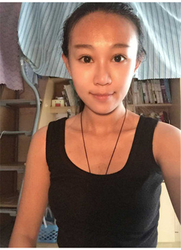 大家早上好,我来分享我的双眼皮经历啦!!都进来看看吧,只要注意忌口和听医生的话,是不会有疤痕的哦~~~