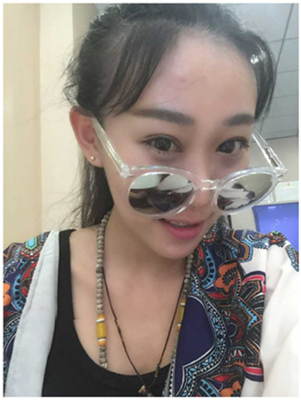 大家早上好,我来分享我的双眼皮经历啦!!都进来看看吧,只要注意忌口和听医生的话,是不会有疤痕的哦~~~