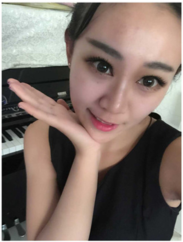 大家早上好,我来分享我的双眼皮经历啦!!都进来看看吧,只要注意忌口和听医生的话,是不会有疤痕的哦~~~