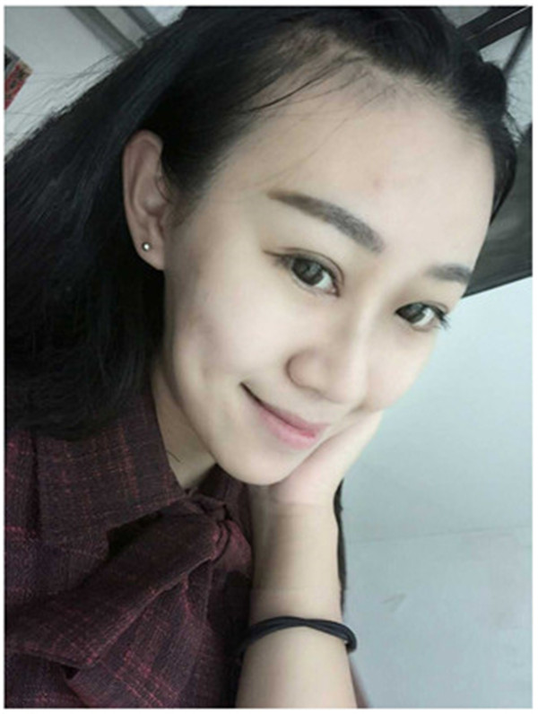 大家早上好,我来分享我的双眼皮经历啦!!都进来看看吧,只要注意忌口和听医生的话,是不会有疤痕的哦~~~