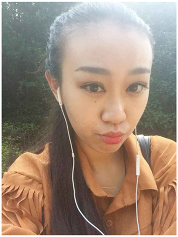 大家早上好,我来分享我的双眼皮经历啦!!都进来看看吧,只要注意忌口和听医生的话,是不会有疤痕的哦~~~