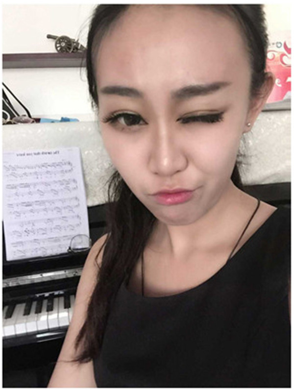 大家早上好,我来分享我的双眼皮经历啦!!都进来看看吧,只要注意忌口和听医生的话,是不会有疤痕的哦~~~