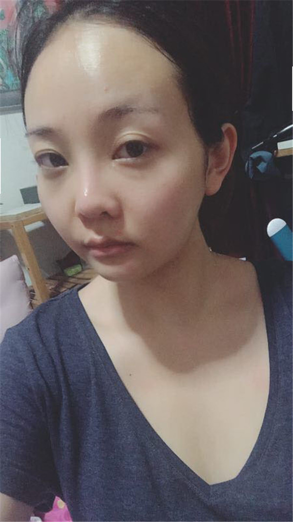分享我的自体脂肪面部填充经历,我以前的面部情况真的是属于面部凹陷很严重的,整个人看起来真的很憔悴,自从做了面填之后就真的完全改良了我的样貌!