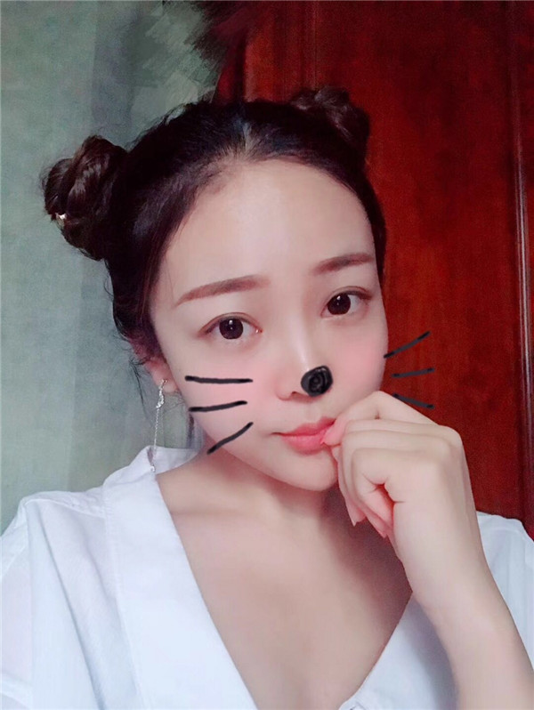 分享我的自体脂肪面部填充经历,我以前的面部情况真的是属于面部凹陷很严重的,整个人看起来真的很憔悴,自从做了面填之后就真的完全改良了我的样貌!