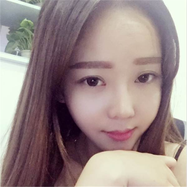 分享我的自体脂肪面部填充经历,我以前的面部情况真的是属于面部凹陷很严重的,整个人看起来真的很憔悴,自从做了面填之后就真的完全改良了我的样貌!