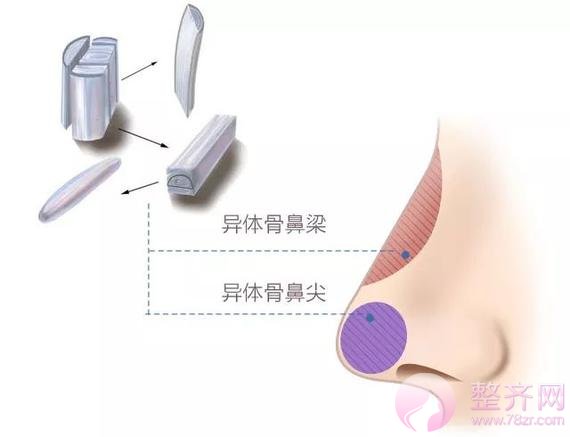 异体肋软骨隆鼻，真的行得通吗？