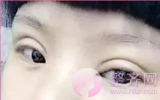 为什么亚洲人不适合做宽的双眼皮？