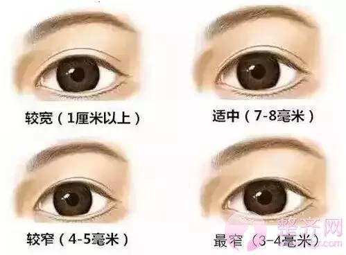 为什么亚洲人不适合做宽的双眼皮？