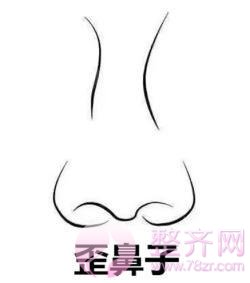 鼻部手术改变9种典型丑鼻子