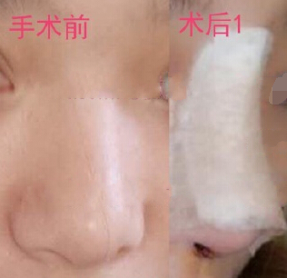 重庆军美整形医院章小平医生鼻部手术(膨体)