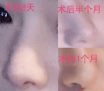 重庆军美整形医院章小平医生鼻部手术(膨体)