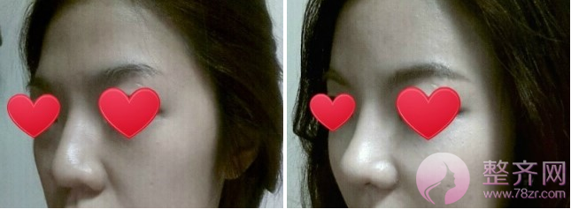 上海鼻部手术手术，面部填充术后5个月案例