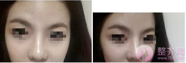 上海鼻部手术手术，面部填充术后5个月案例
