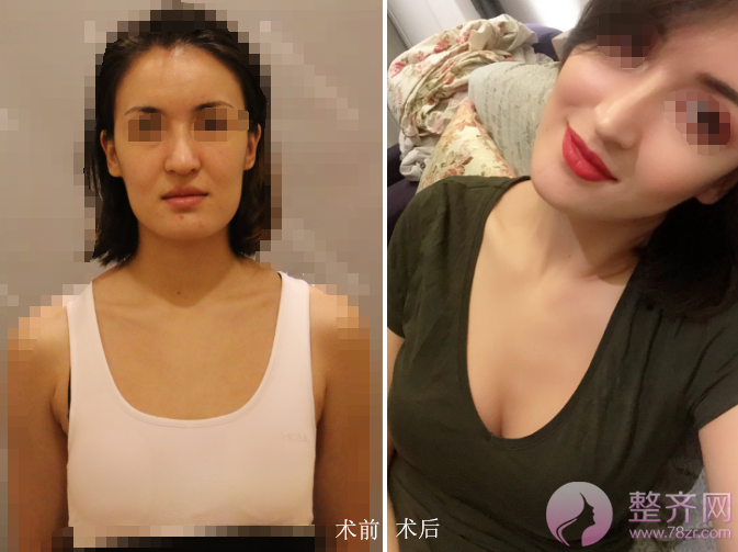 上海自体脂肪面部填充、隆胸术后90天案例分享