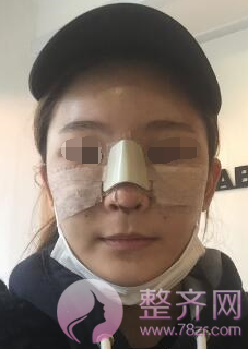 武汉鼻部手术、面部脂肪填充手术术后2个月案例分