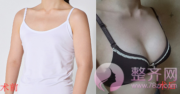 北京假体隆胸案例，假体隆胸果
