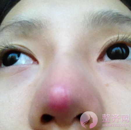 进行假体隆鼻术后，鼻尖为何发红？