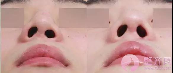 进行假体隆鼻术后，鼻尖为何发红？