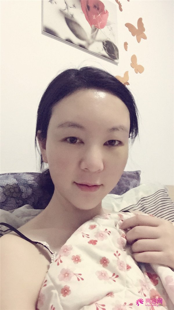 北京自体脂肪填充脸部案例价格果真人分享