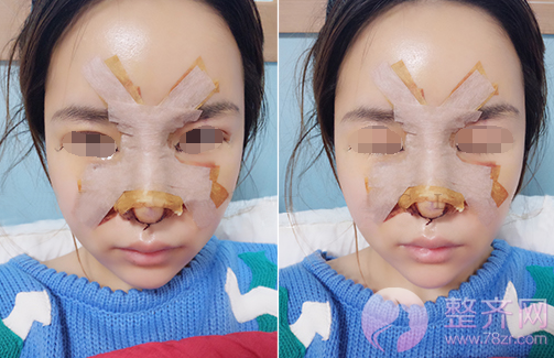 武汉假体隆鼻术后180天案例