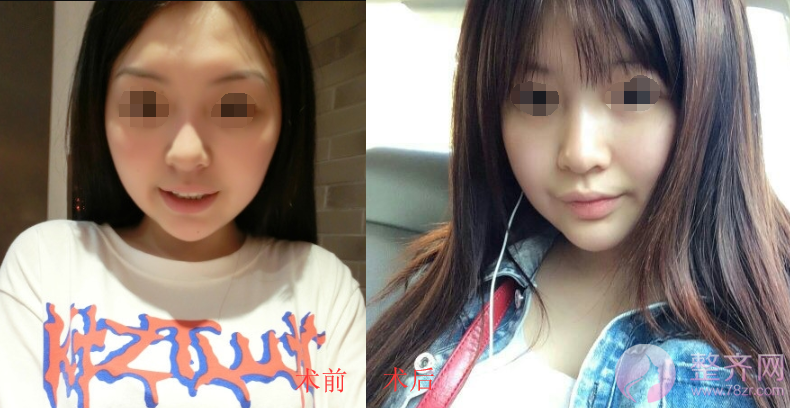 北京鼻部手术案例术后220天日记