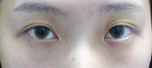深圳眼部手术案例95天