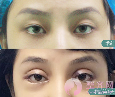 上海眼部手术案例，双眼皮带来的魅力