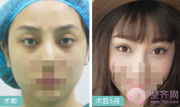 上海眼部手术案例，双眼皮带来的魅力