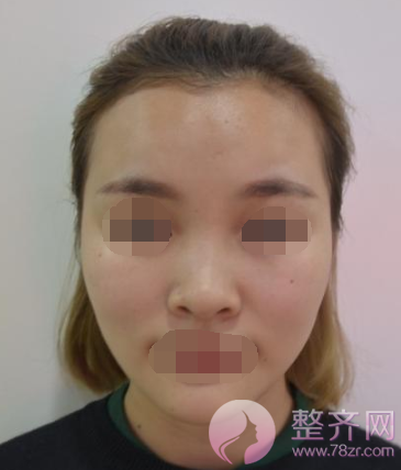 重庆膨体鼻部手术案例术后49天