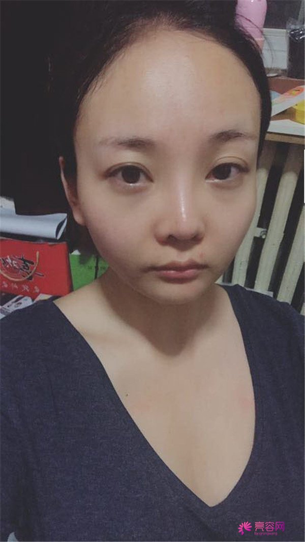 北京自体脂肪填充医院案例术后反馈分享,果怎么样?价格多少钱?一看便知!