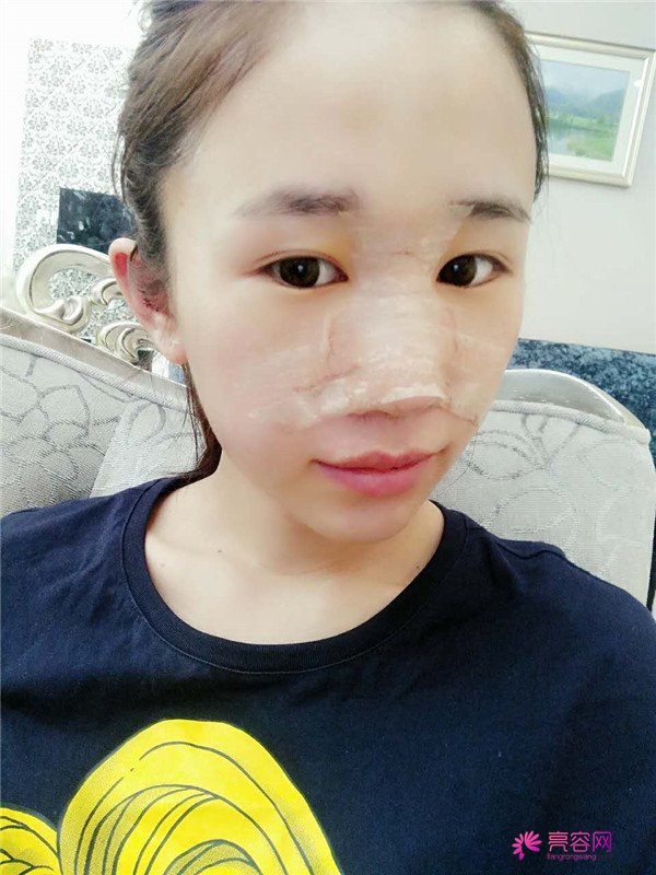 福建膨体隆鼻医院案例术后反馈分享,果怎么样?价格多少钱?一看便知!