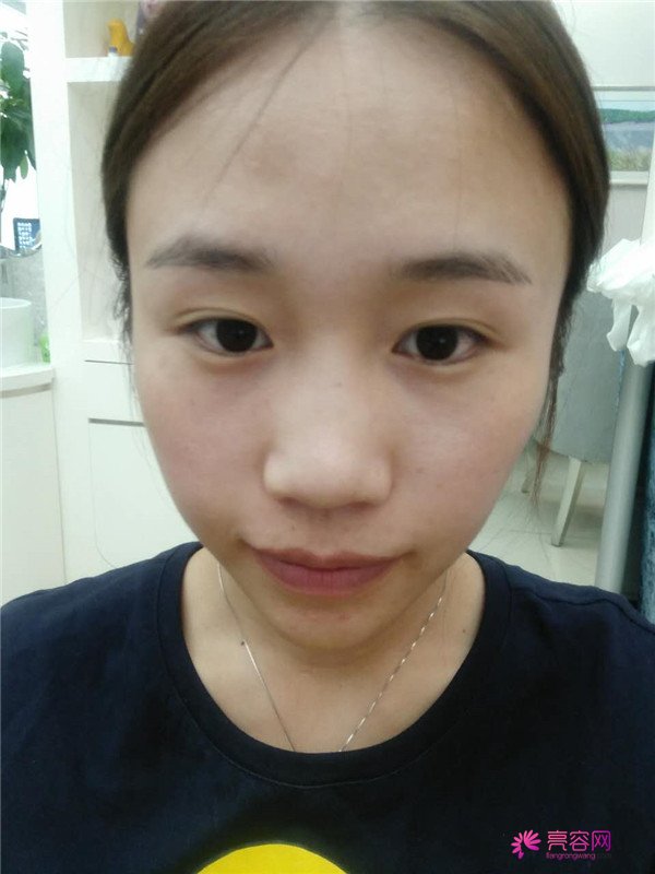 福建膨体隆鼻医院案例术后反馈分享,果怎么样?价格多少钱?一看便知!