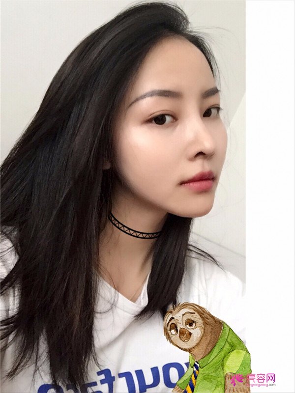 我来和大家分享我的隆鼻日记了,我自己恢复得不错,所以放心大胆的将自己的鼻子交给医院啦~